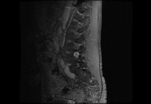 Bildgebung - MRT sagittal T1-Wichtung mit KM