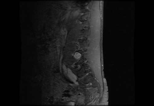 Bildgebung - MRT sagittal T1-Wichtung mit KM