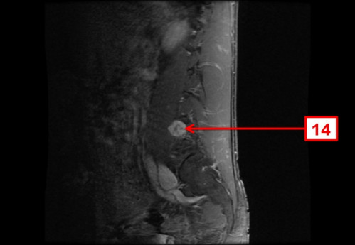 Bildgebung - MRT sagittal T1-Wichtung mit KM nummeriert