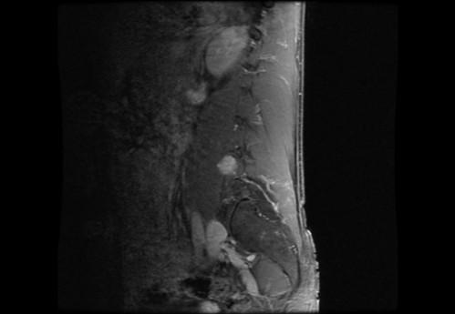 Bildgebung - MRT sagittal T1-Wichtung mit KM