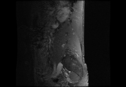 Bildgebung - MRT sagittal T1-Wichtung mit KM