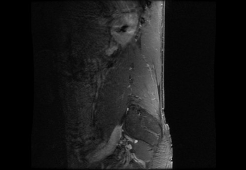 Bildgebung - MRT sagittal T1-Wichtung mit KM