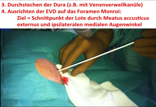 Operationstechnik - EVD-Anlage 