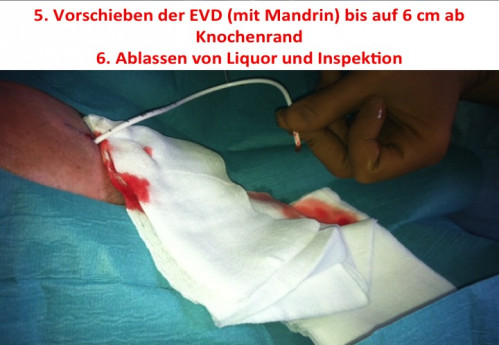 Operationstechnik - EVD-Anlage 