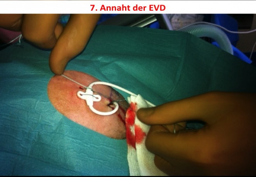 Operationstechnik - EVD-Anlage 