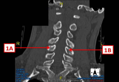 Bildgebung (1-präoperativ) - CT, HWS, sagittal und koronar; MRT, HWS, sagittal, T2-Wichtung