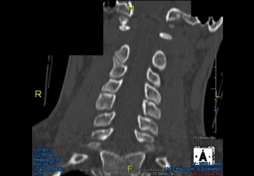 Bildgebung (1-präoperativ) - CT, HWS, sagittal und koronar; MRT, HWS, sagittal, T2-Wichtung