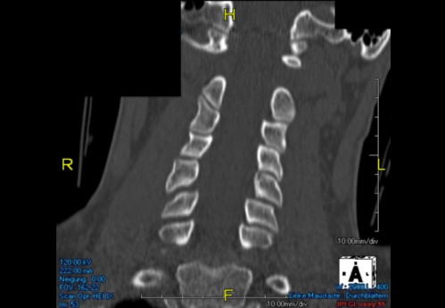 Bildgebung (1-präoperativ) - CT, HWS, sagittal und koronar; MRT, HWS, sagittal, T2-Wichtung