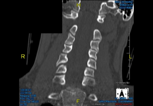 Bildgebung (1-präoperativ) - CT, HWS, sagittal und koronar; MRT, HWS, sagittal, T2-Wichtung