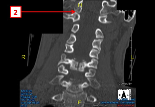 Bildgebung (1-präoperativ) - CT, HWS, sagittal und koronar; MRT, HWS, sagittal, T2-Wichtung