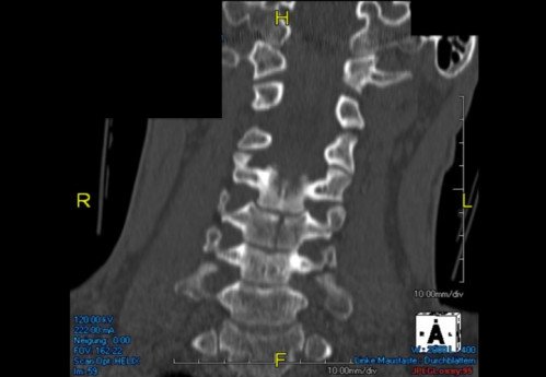 Bildgebung (1-präoperativ) - CT, HWS, sagittal und koronar; MRT, HWS, sagittal, T2-Wichtung