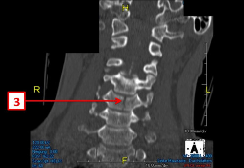 Bildgebung (1-präoperativ) - CT, HWS, sagittal und koronar; MRT, HWS, sagittal, T2-Wichtung