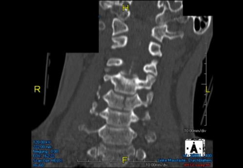 Bildgebung (1-präoperativ) - CT, HWS, sagittal und koronar; MRT, HWS, sagittal, T2-Wichtung