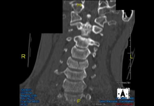Bildgebung (1-präoperativ) - CT, HWS, sagittal und koronar; MRT, HWS, sagittal, T2-Wichtung