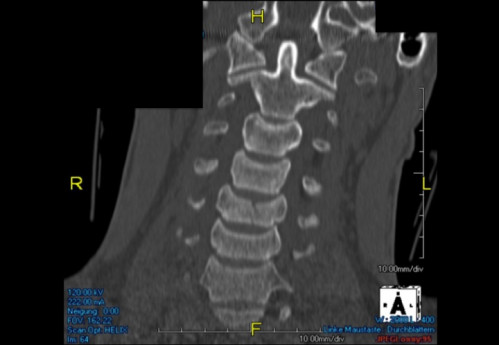 Bildgebung (1-präoperativ) - CT, HWS, sagittal und koronar; MRT, HWS, sagittal, T2-Wichtung