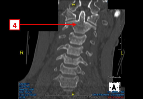 Bildgebung (1-präoperativ) - CT, HWS, sagittal und koronar; MRT, HWS, sagittal, T2-Wichtung