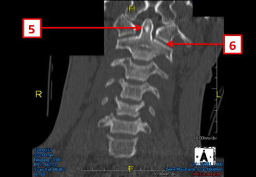 Bildgebung (1-präoperativ) - CT, HWS, sagittal und koronar; MRT, HWS, sagittal, T2-Wichtung