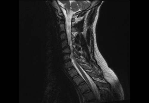 Bildgebung (1-präoperativ) - CT, HWS, sagittal und koronar; MRT, HWS, sagittal, T2-Wichtung