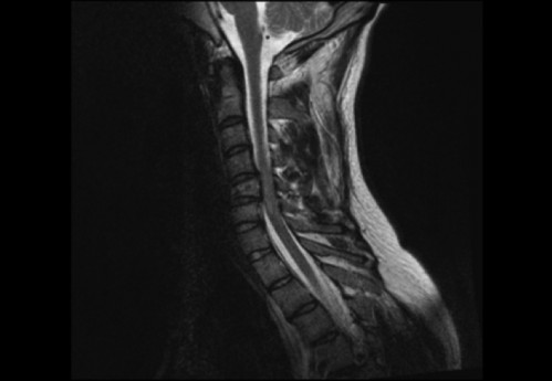 Bildgebung (1-präoperativ) - CT, HWS, sagittal und koronar; MRT, HWS, sagittal, T2-Wichtung
