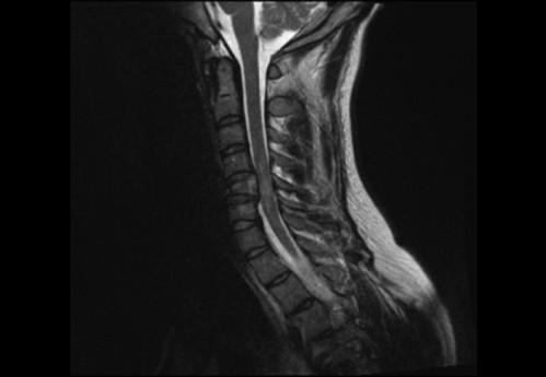 Bildgebung (1-präoperativ) - CT, HWS, sagittal und koronar; MRT, HWS, sagittal, T2-Wichtung