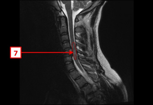 Bildgebung (1-präoperativ) - CT, HWS, sagittal und koronar; MRT, HWS, sagittal, T2-Wichtung