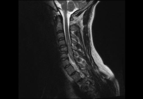 Bildgebung (1-präoperativ) - CT, HWS, sagittal und koronar; MRT, HWS, sagittal, T2-Wichtung