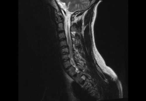 Bildgebung (1-präoperativ) - CT, HWS, sagittal und koronar; MRT, HWS, sagittal, T2-Wichtung