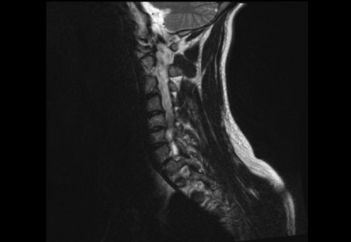 Bildgebung (1-präoperativ) - CT, HWS, sagittal und koronar; MRT, HWS, sagittal, T2-Wichtung
