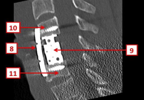 Bildgebung (2-postoperativ) - CT, HWS, sagittal und 3D-Rekonstruktionen