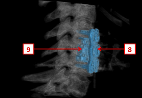 Bildgebung (2-postoperativ) - CT, HWS, sagittal und 3D-Rekonstruktionen