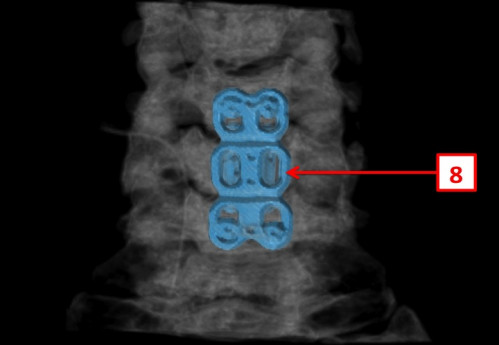 Bildgebung (2-postoperativ) - CT, HWS, sagittal und 3D-Rekonstruktionen