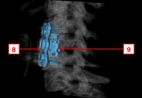 Bildgebung (2-postoperativ) - CT, HWS, sagittal und 3D-Rekonstruktionen