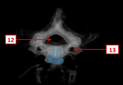Bildgebung (2-postoperativ) - CT, HWS, sagittal und 3D-Rekonstruktionen