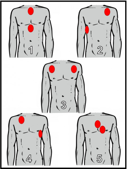 Skizze - Position der Elektroden zur Defibrillation
