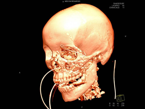 Bildgebung - 3D CT postoperativ