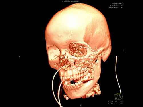 Bildgebung - 3D CT postoperativ