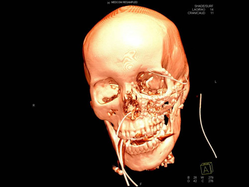 Bildgebung - 3D CT postoperativ