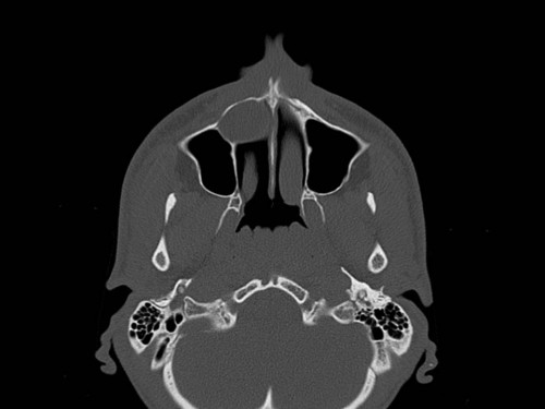 Bildgebung - CT axial präoperativ