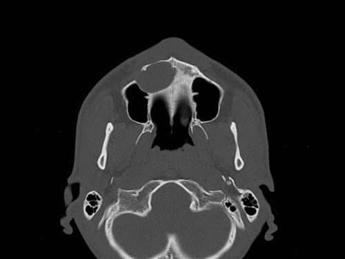 Bildgebung - CT axial präoperativ