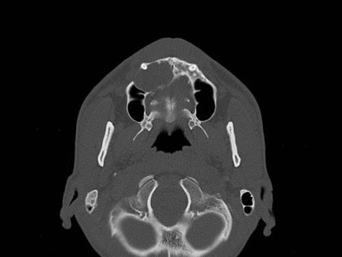 Bildgebung - CT axial präoperativ