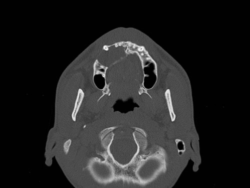 Bildgebung - CT axial präoperativ