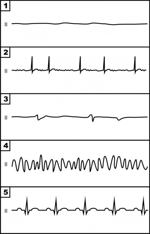 Elektrokardiogramm - 5 verschiedene Rhythmen