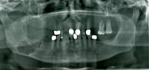 Bildgebung - OPAN postoperativ (aktuell)