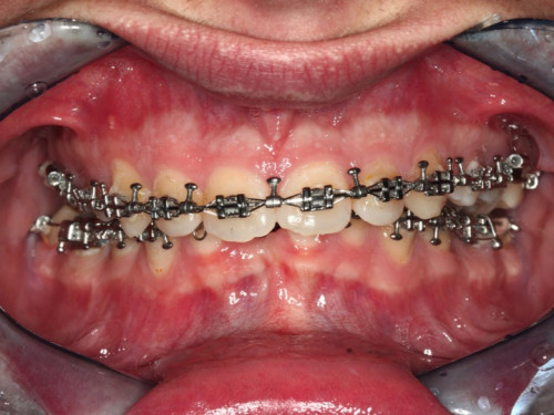 Makroskopie - intraoral 1 präoperativ