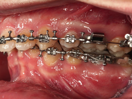 Makroskopie - intraoral 2 präoperativ
