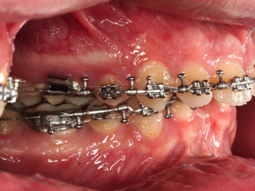 Makroskopie - intraoral 3 präoperativ