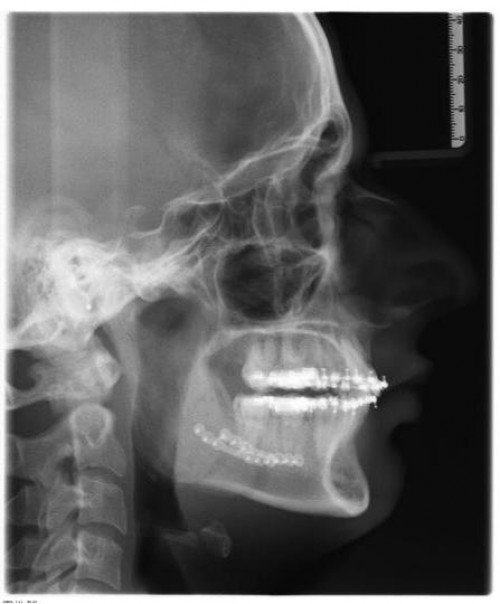 Bildgebung - FRS postoperativ