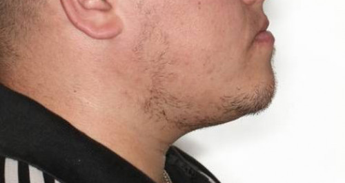 Makroskopie - Profil präoperativ