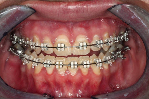 Makroskopie - intraoral 1 präoperativ