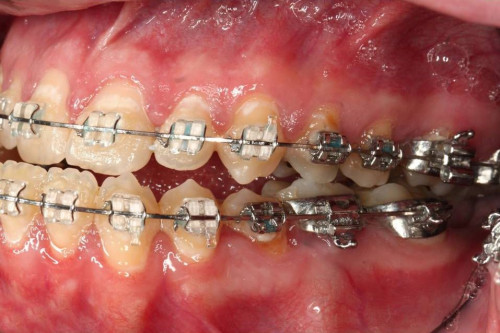 Makroskopie - intraoral 2 präoperativ
